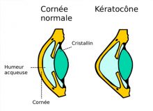 keratocone-pathologie
