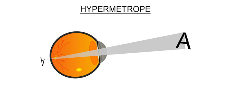 hypermetrope